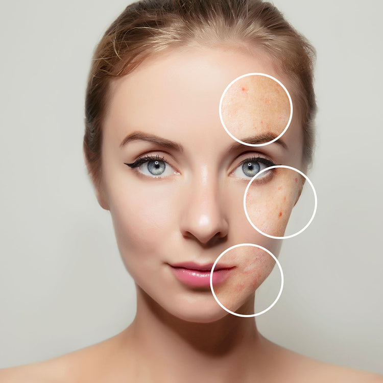 Skin Concerns - Acne Skin