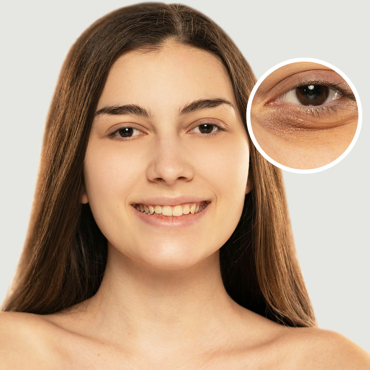 Skin Concerns - Eye Bags and Dark Circles