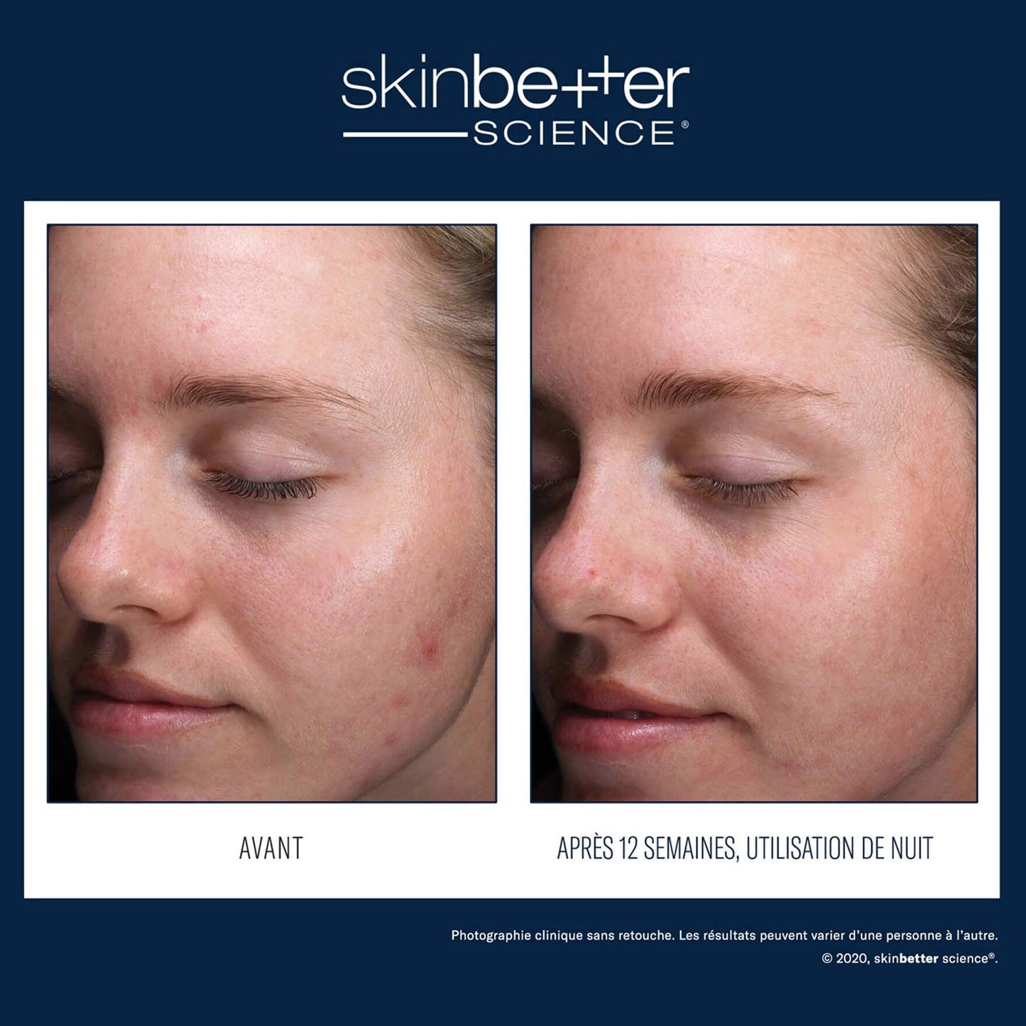 Skinbetter Science: AlphaRet Clearing Serum 30ml