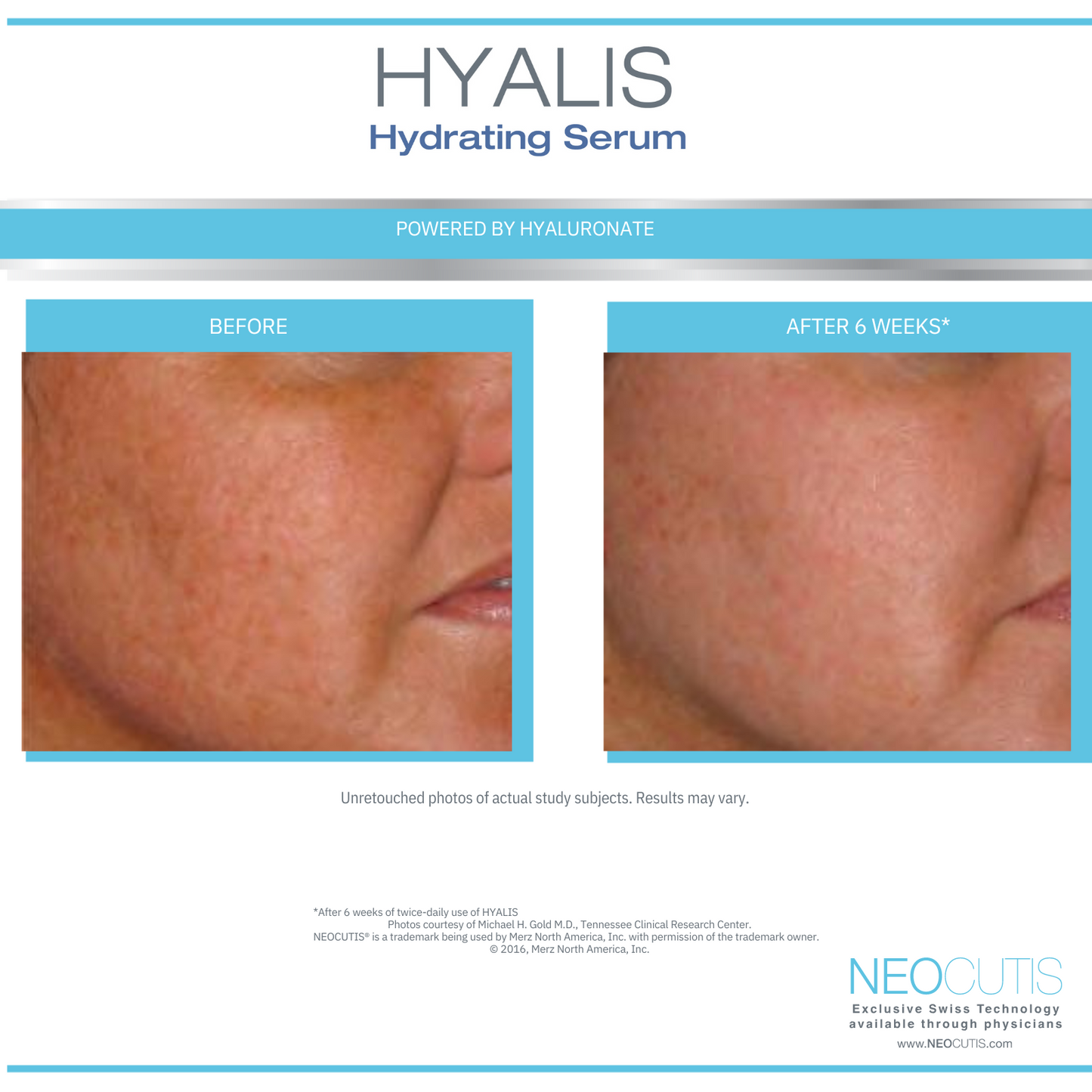 NeoCutis Hyalis+ Intensive Hydrating Serum 30 ml / 1 fl oz