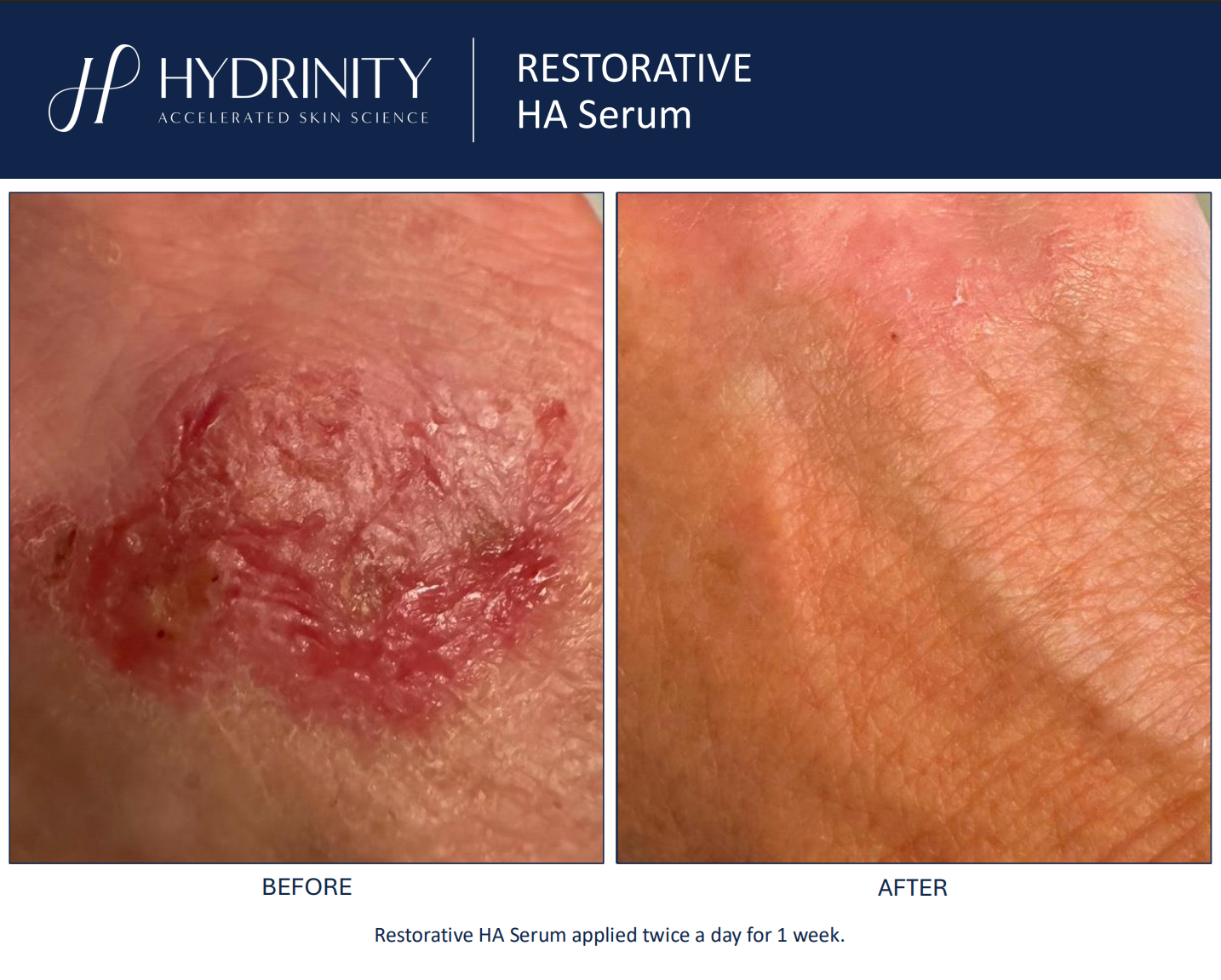 Hydrinity: Restorative HA Serum with PPM⁶ Technology | 30ml