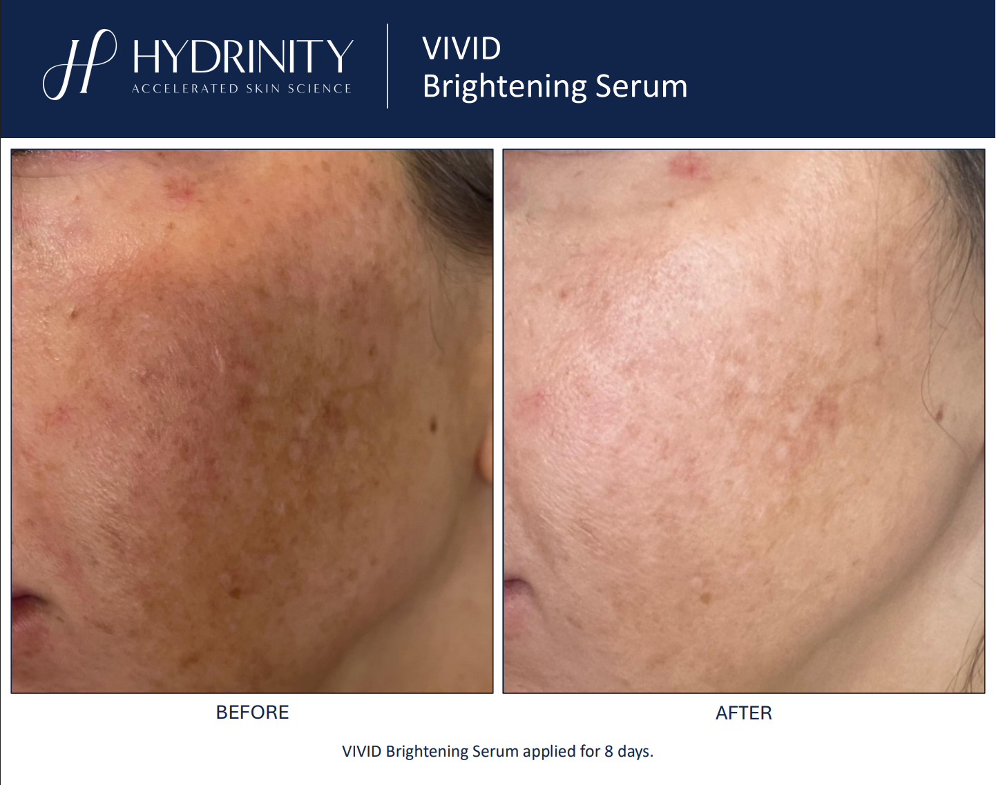 Hydrinity: Vivid Brightening Seurm | 30ml