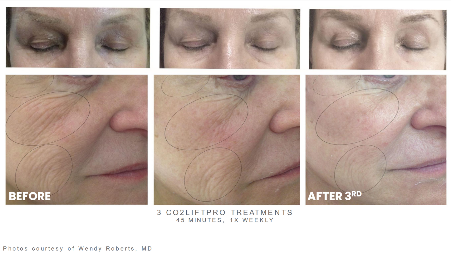 CO2Lift Pro Topical Carboxy – 1 Treatment Box
