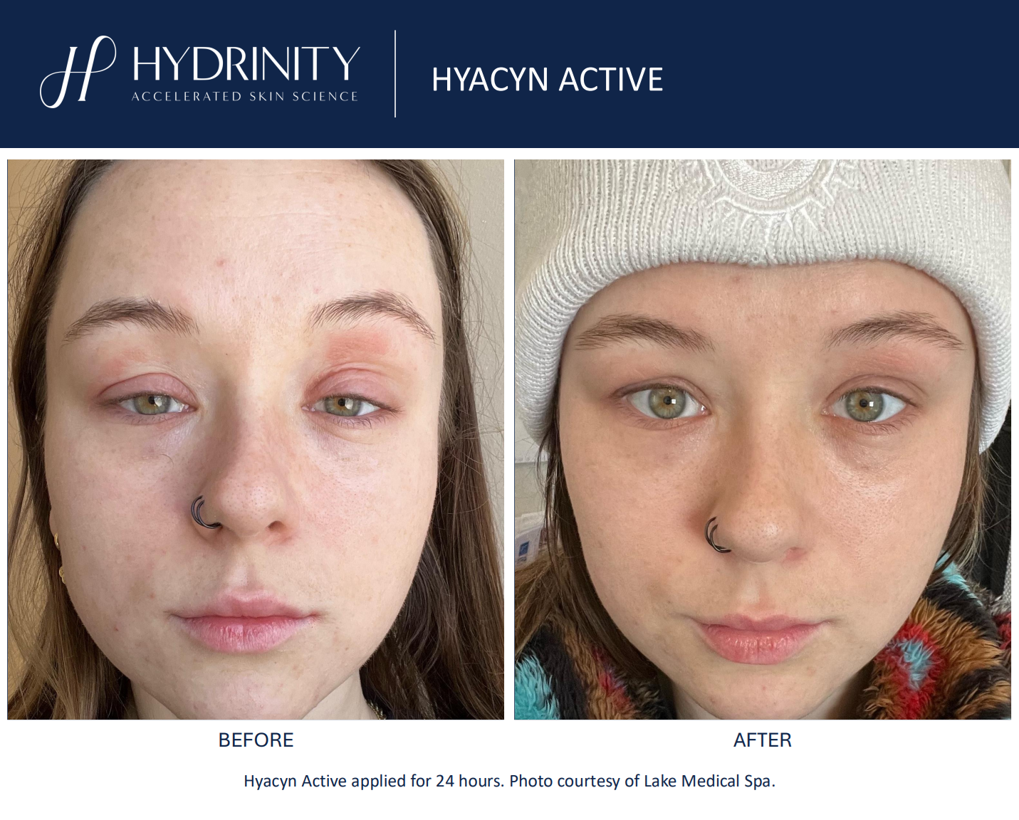 Hydrinity: Hyacyn Active | 90ml
