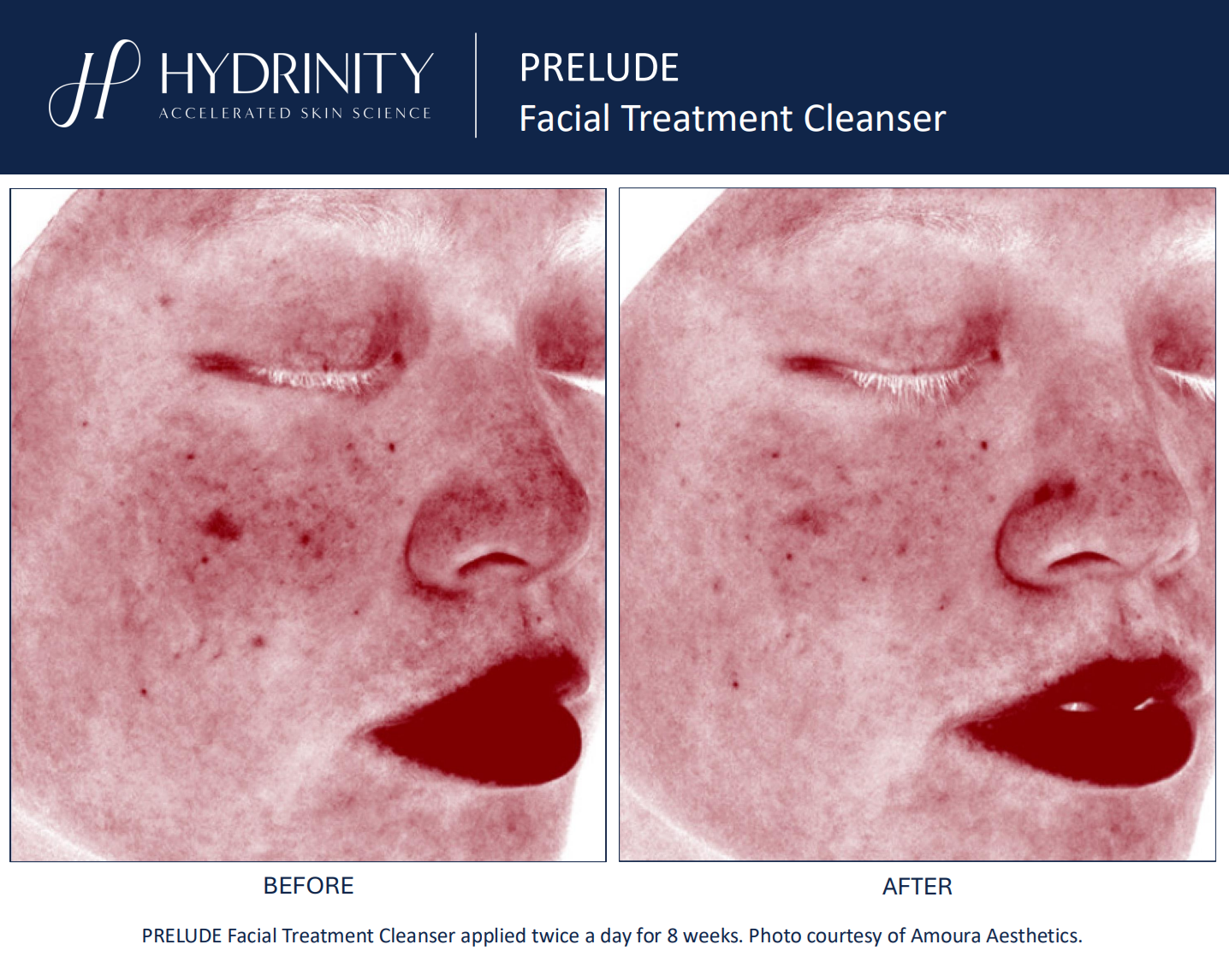 Hydrinity: Prelude Facial Treatment Cleanser | 180ml