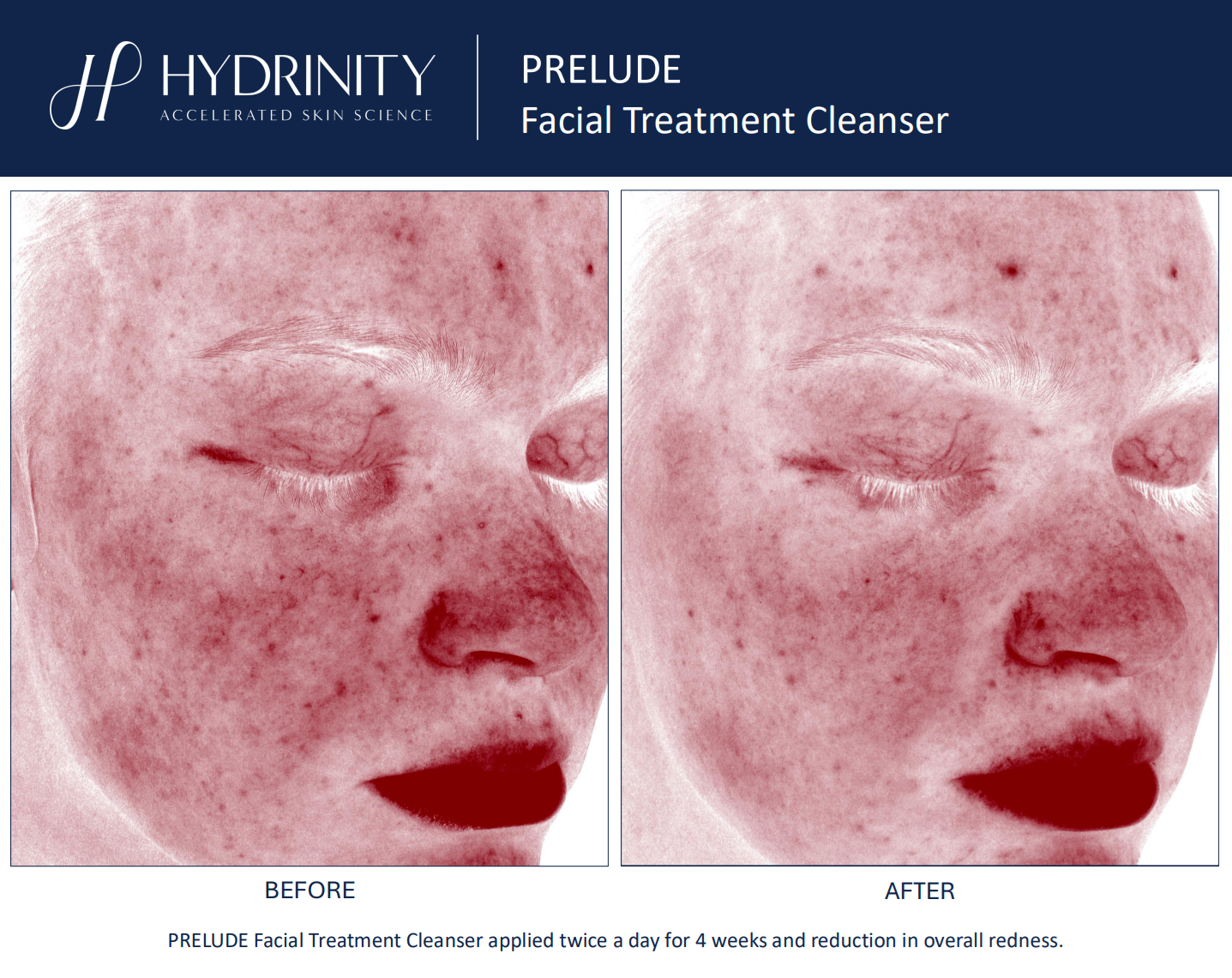 Hydrinity: Prelude Facial Treatment Cleanser | 180ml