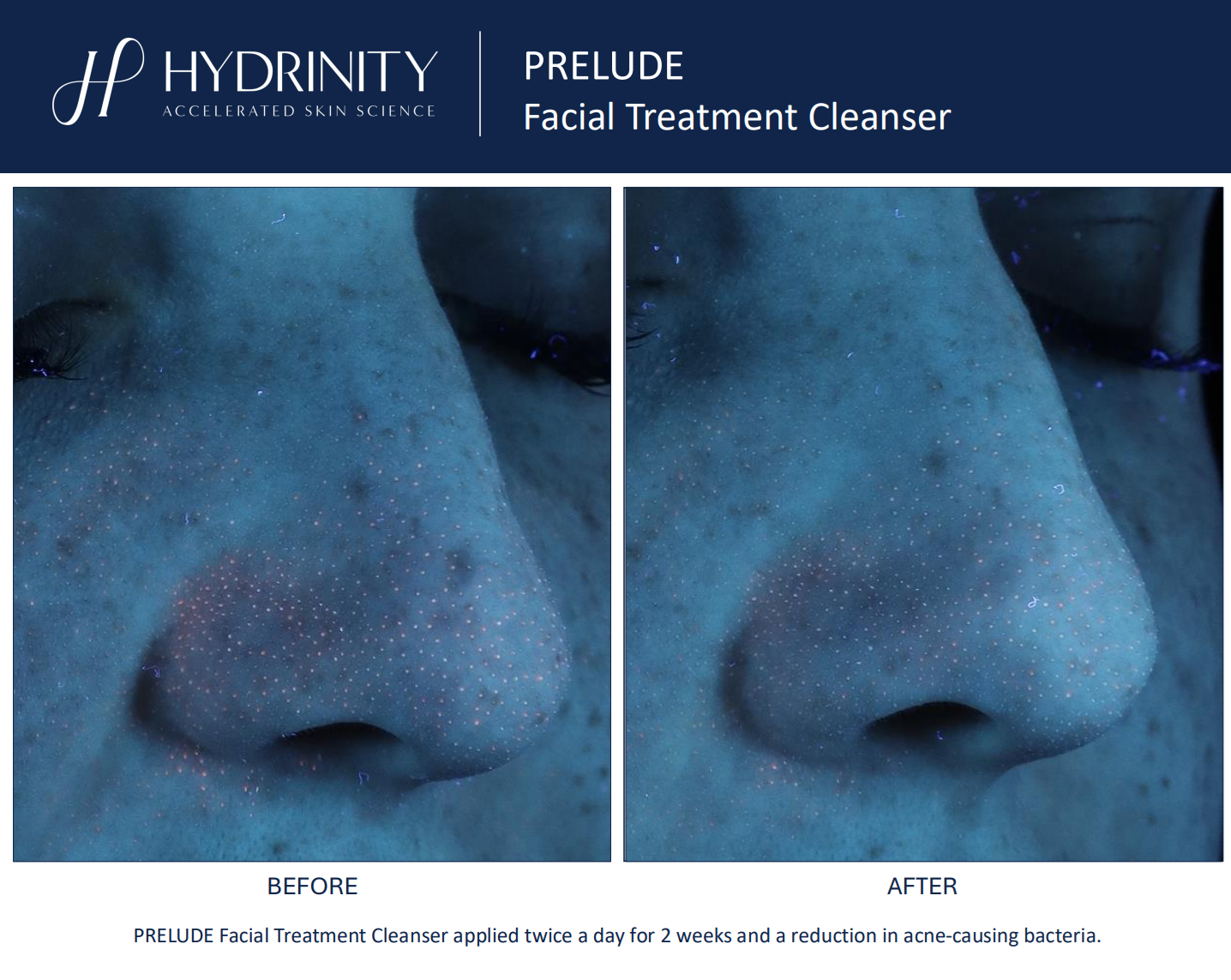 Hydrinity: Prelude Facial Treatment Cleanser | 180ml
