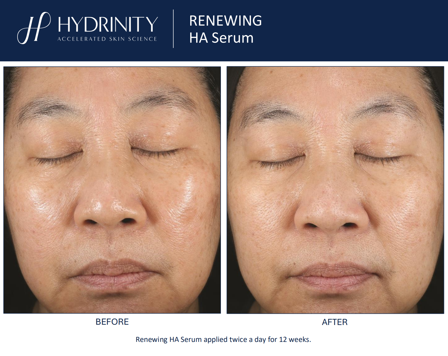 Hydrinity: Renewing HA Serum with PPM⁶ Technology | 30ml