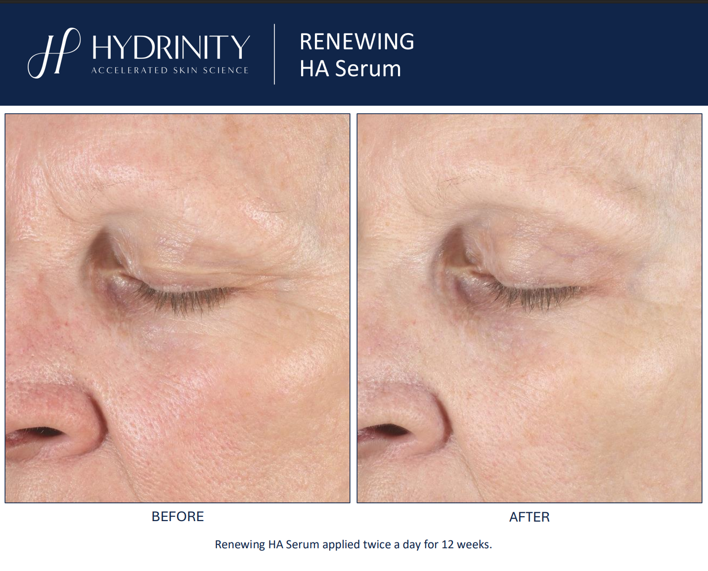 Hydrinity: Renewing HA Serum with PPM⁶ Technology | 30ml