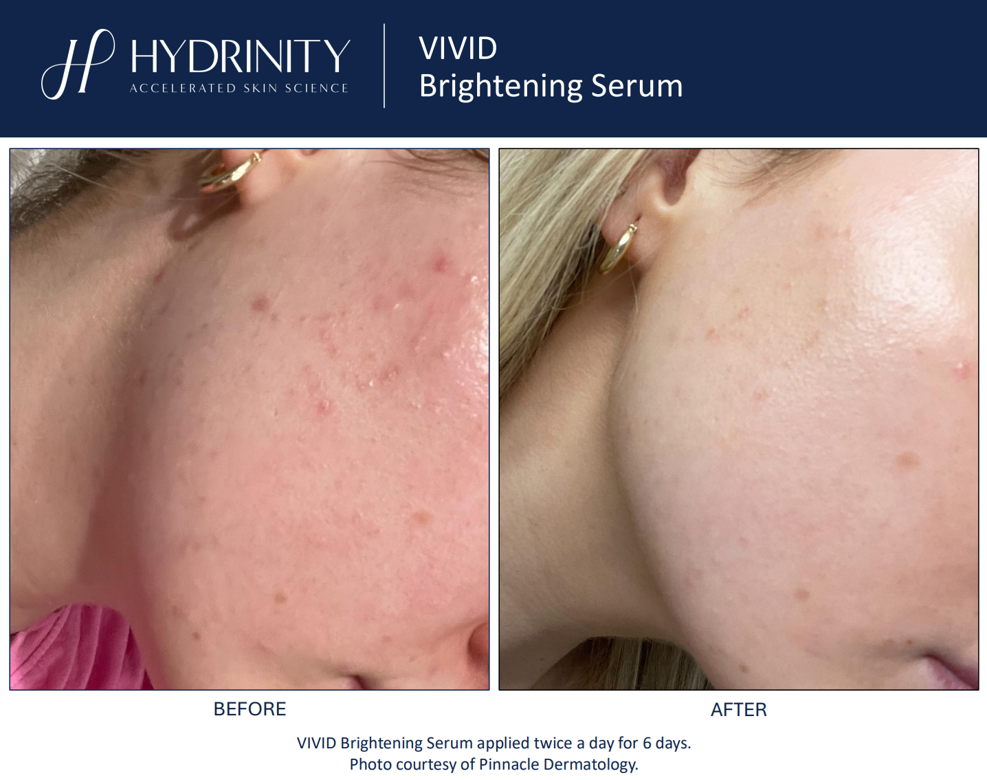 Hydrinity: Vivid Brightening Seurm | 30ml
