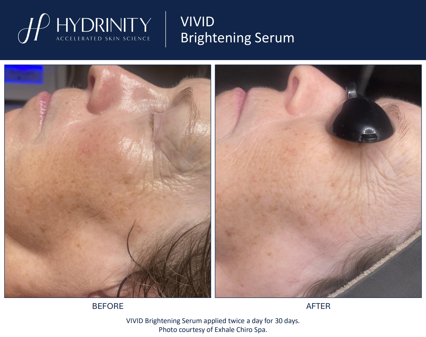 Hydrinity: Vivid Brightening Seurm | 30ml